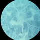 Choroidal atrophy Choroidal atrophy